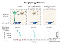 Impaired and then loss of inhibitory NO activity
- Normal: excitatory ACh maintains LES tone and inhibitory NO releases to relax LES and allow bolus passage
- Achalasia w/ loss of inhibitory NO activity: elevates LES pressure and inability to in...