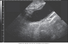 Tubes can be examined by ultrasound for ______ and to assess patency. 
