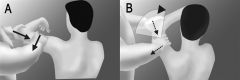 1-KIV=intra-articular contrast (MRI arthrogram) increases sensitivity for labral pathology, XRAY-nl
Dx-Posterior Labral Tear aka reverse Bankart lesion
1.1-sx=shoulder pain, sense of instability, mechanical symptoms (clicking, popping) w/ ROM
P...