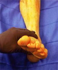A 54-year-old female has a painful flatfoot that has not improved with over 8 months of conservative management with orthotics. Preoperatively, she was unable to perform a single-heel rise and her hindfoot was passively correctable. Figures A and ...