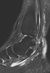 A 44-year-old female has a Stage 2B acquired flat foot deformity that does not improve over 6 months of conservative management. She undergoes FDL tendon transfer to the navicular, calcaneal osteotomy, and tendoachilles lengthening. After this cor...