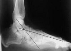 Plantarflexion opening wedge medial cuneiform osteotomy is an adjunctive procedure used to correct the forefoot varus (Illustration A) component of a flatfoot deformity as described in the review article by Tankson. In acquired flat foot deformity...