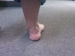 A 56-year-old woman comes to your office with foot pain after a 9 month trial of orthotics. Your examination reveals the hindfoot is in valgus, the arch is depressed, and the forefoot is abducted when the foot is viewed posteriorly. She is unable ...