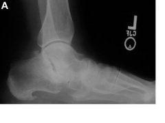 Image demonstrates the "too many toes" sign consistent with posterior tibialis tendon dysfunction. Failure of the hindfoot to correct during physical exam renders this a fixed rather than flexible deformity (Stage III) warranting triple arthrodesi...