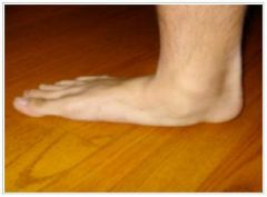 A 46-year-old obese female presents with foot pain and the radiographs shown in Figures A and B. Which of the following physical findings will most likely be present?  
1.  Achilles tendon contracture 
2.  Hallux varus 
3.  Forefoot adduction 
...