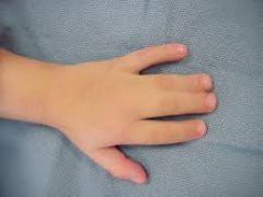 Syndactyly is associated with all of the following conditions EXCEPT? 
1.  Apert syndrome 
2.  Poland's syndrome 
3.  Holt-Oram syndrome 
4.  Carpenter syndrome 
5.  Tay-Sach's Disease