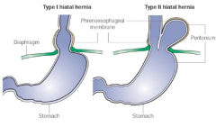 - Separation of the diaphragmatic crura and LES
- Leads to a protrusion of the stomach into the thorax through the gap
