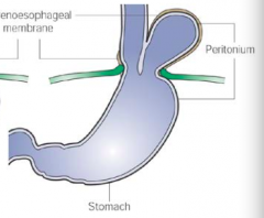 Type II / Para-esophageal Hiatal Hernia
- Less common
- A part of the stomach herniates through the esophageal hiatus and lies beside the esophagus, without movement of the gastroesophageal junction