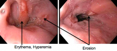 - Simple hyperemia / redness may be the only sign

- Basal Zone Hyperplasia >20% of the total epithelial thickness, may be present
- Elongation of lamina propria papillae that extends into the upper 1/3 of the epithelium, may be present
- Eros...