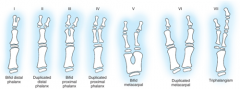The Bilhaut-Cloquet procedure for thumb duplication, where the central portions of bone and nail are removed and the radial half of one thumb is combined with the ulnar half of the other to create one thumb, is most appropriate in which Wassel Typ...