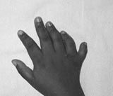 ostaxial polydactyly, which is more prevalent in patients of African-American ancestry. 

The cohort study by Woolf found the incidence of postaxial polydactyly in African americans is 12.42 per 1,000 (1.2%) compared to the Caucasian incidence o...