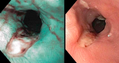 Esophageal Ulcer - can be a complication of GERD
