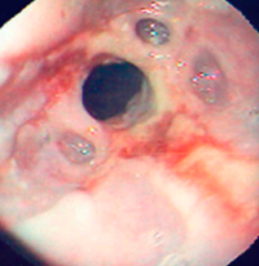 Esophageal Stricture
- Most often d/t inflammation and scarring caused by chronic GERD, radiation, or caustic injury
- Narrowing generally caused by fibrous thickening of submucosa, atrophy of the muscularis propria, and/or secondary epithelial ...