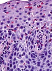 Histologic confirmation of >15 eosinophils / HPF in esophageal mucosa