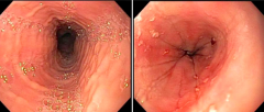 - Endoscopic appearance is helpful but not required for diagnosis
- Corrugated esophagus on left
- Longitudinal furrows and white abscesses (exudates) on right