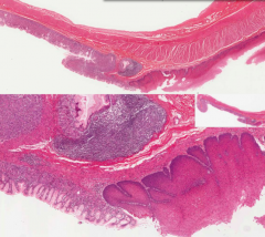 Gastro-Esophageal Junction
- Purple mucosa on left is Columnar (as seen in the intestine)
- Pink mucosa on the right is Stratified Squamous (as seen in the esophagus)