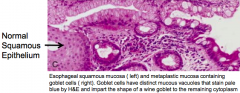 Goblets cells (w/ their distinct mucous vacuoles) define intestinal metaplasia (upper right)