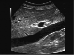 how can the sonographer determine that the inferior vena cava is dilated?