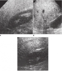 what liver disease is present in these images?