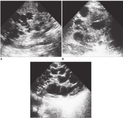 what liver abnormality is demonstrated? what other area should the sonographer investigate?