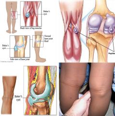 A Baker's cyst, also known as a popliteal cyst, is a benign swelling of the semimembranous or more rarely some other synovial bursa found behind the knee joint. This is not a "true" cyst, as an open communication with the synovial sac is often mai...