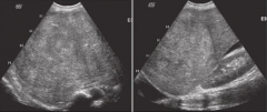 a patient with a history of cirrhosis shows evidence of hepatomegaly. what are the possible sonographic findings?