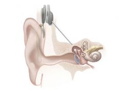cochlea implants (CI)