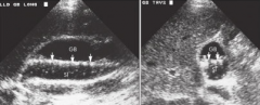 describe what arrows are pointing to in this image of the gallbladder?