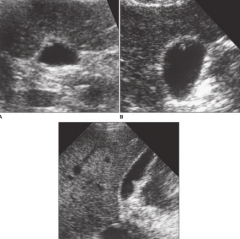 describe the sonographic findings in these images