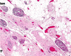 Are the islets preserved in chronic pancreatitis? Why?