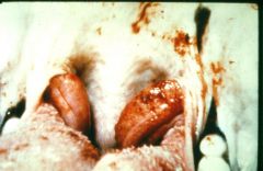 what disease are these enlarged lymphnodes associated with? what if there are echymotic hemorrhages on mucosa?