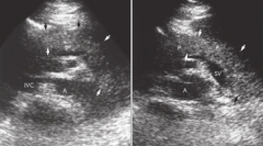 a 45-year-old male presents with midepigastric pain, elevated amylase and lipase levels, and tenderness.
 
identify the sono. findings