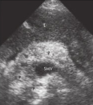 patient with acute pancreatitis presents with continued pain.
 
describe sono. findings
