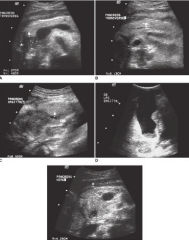 56 yr old male with a 1-week of jaundice and pain has reported a 3-month history of nausea, vomiting, weight loss, and diarrhea.
 
What are the sonographic findings