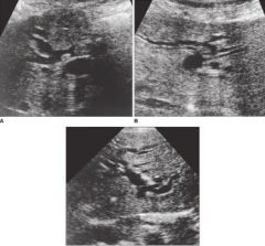 60 yr old female presents with a history of cholecystectomy several years ago. known to have had previoud hepatic calculi and now presents right upper quadrant pain.
 
What questions should be asked? describe sonographic findings