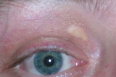 i. Atheromata: plaques in blood vessel walls
ii. Xanthoma: yellow plaques or nodules in the skin especially eyelids
iii. tendinous xanthoma: lipid deposit in tendon (esp. Achilles)
iv. corneal arcus: lipid deposit in cornea