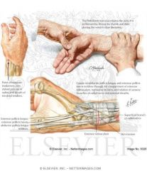i. pain on palpation of tendon sheath
ii. finklestein's test