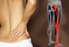 Sciatica is a set of symptoms including pain caused by general compression or irritation of one of five spinal nerve roots of each sciatic nerve—or by compression or irritation of the left or right or both sciatic nerves. Symptoms include lower ...