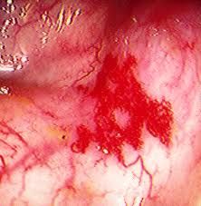Tortuous, dilated veins in the submucosa of the colon (usually proximal) wall
- a common cause of lower GI bleeding in patients over the age of 60
- bleeding is usually low grade, but 15% of patients may have massive hemorrhage if veins rupture
...