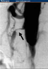 1. mesenteric angiography- definitive diagnostic test
2. obtain a plain film of the abdomen to exclude other causes of abdominal pain
3. "Thumbprinting" on barium enema is due to thickened edematous mucosal folds