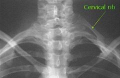 An extra rib or pair of ribs arising from the 7th cervical vertebrae

This can cause Thoracic Outlet Syndrome (not always)