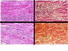 Which image shows lymphocytic myocarditis?