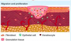 Proliferation
- Fibroblasts, smooth muscle cells, and endothelial cells infiltrate wound and reestablish tissue continuity
- Fibroblasts proliferate and synthesize collagen and matrix metalloproteinases
- Epithelialization reestablishes externa...