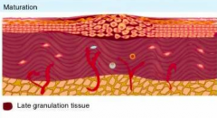 Maturation
- Granulation tissue remodeling and scar formation
- Inflammatory cells cleared from scar tissue
- Myofibroblasts undergo apoptosis
- Collagen undergoes reabsorption to remodel and strengthen wound
