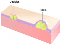 - Vesicle: fluid-filled, <1 cm in diameter
- Bulla: fluid-filled, >1 cm in diameter

- Pustule: pus-filled blister