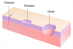 - Erosion: open area w/ partial or full loss of epidermis
- Ulcer: open area w/ loss of part of dermis
- Fissure: linear ulcer