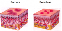 - Purpura: area of hemorrhage
- Petechiae: pinpoint purpura
