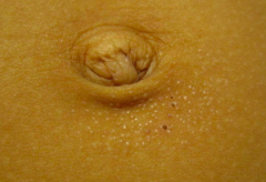 • Location – Abdomen (periumbilical)
• Primary lesion – PAPULE (elevated, palpable, <1 cm)
• Size – 1mm
• Color – Skin-colored
• Number – 40-50
• Configuration – Clustered
• Secondary change – Excoriation/crusting...