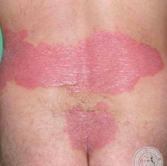 • Location – Lower back and buttocks
• Primary lesion – PLAQUES (elevated, palpable, >1cm) 
• Color – Pink 
• Shape – Geographic
• Secondary change – Scaly
• Other descriptors – Well-demarcated
