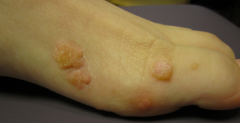 • Location – Foot
• Primary lesion – PAPULES (elevated, palpable, <1cm) and plaques (elevated, palpable, >1cm)
• Size – 2 mm to 1 cm
• Color – Light pink
• Secondary change – Scale
• Other descriptors – Verrucous (warty)